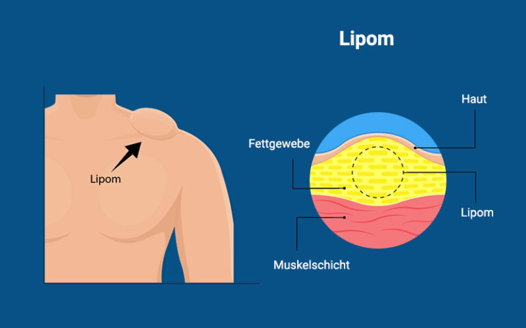 Lipom (Haut Knubbel): Ursachen, Sympome, Entfernen | praktischArzt.ch