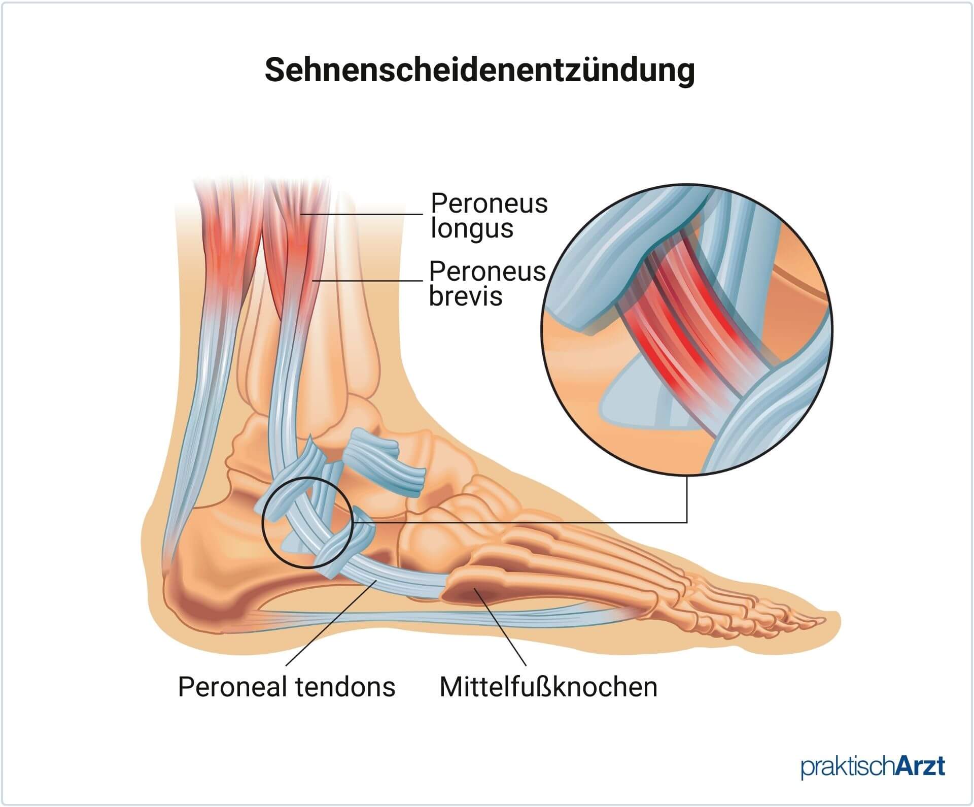 Peronealsehnenentzündung