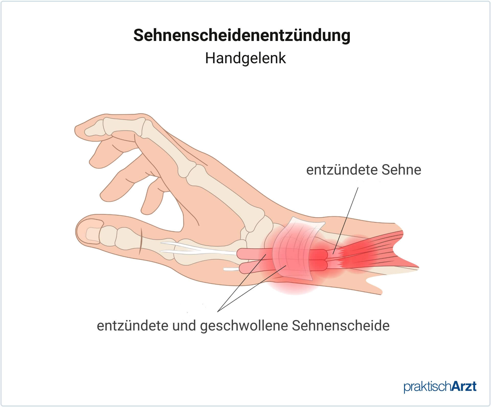 Sehnenscheidenentzündung Hand